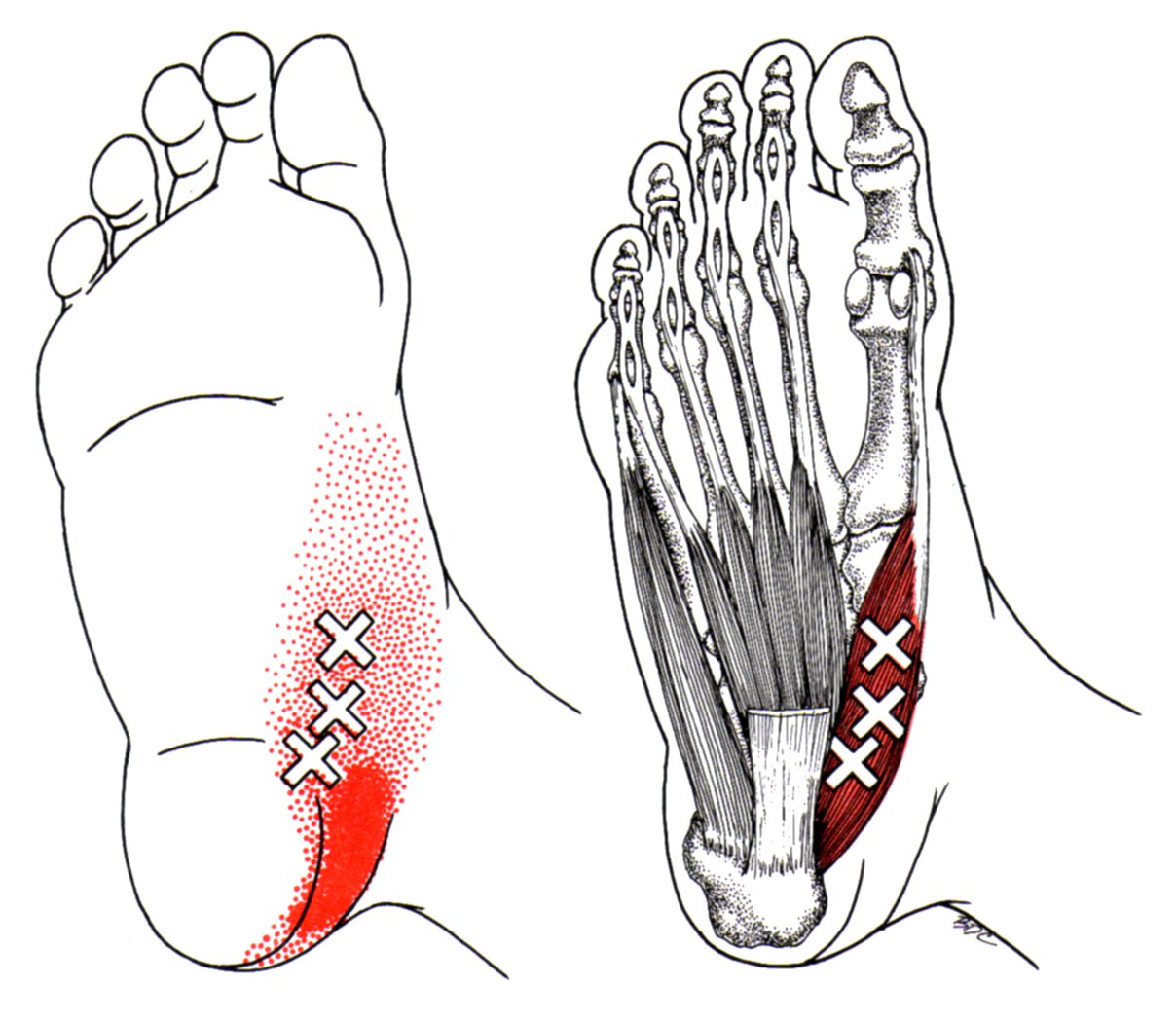 Abductor hallucis the trigger point referred pain guide